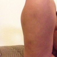 Hai tháng sau khi hút mỡ cánh tay mà tôi vẫn không thấy có kết quả gì, cánh tay bị tụ dịch và trông to hơn trước, như vậy là sao? Hai tháng sau khi hút mỡ cánh tay mà tôi vẫn không thấy có kết quả gì, cánh tay bị tụ dịch và trông to hơn trước, như vậy là sao?