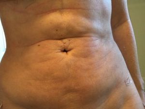 Tôi có nên lo lắng về ngấn bụng lổn nhổn ở bụng sau hút mỡ không?