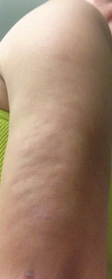 Tôi đã làm hút mỡ dược 2 tháng và cánh tay trông vẫn rất tồi tệ - chỗ lồi chỗ lõm, đau và tê dại – điều này có bình thường không?