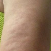 Tôi đã làm hút mỡ dược 2 tháng và cánh tay trông vẫn rất tồi tệ - chỗ lồi chỗ lõm, đau và tê dại – điều này có bình thường không? Tôi đã làm hút mỡ dược 2 tháng và cánh tay trông vẫn rất tồi tệ - chỗ lồi chỗ lõm, đau và tê dại – điều này có bình thường không?