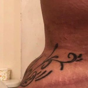 Tôi có thể làm gì để xử lý ổ tụ dịch tái phát?