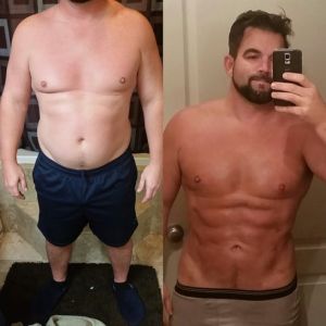 Tụ dịch sau hút mỡ có thể chữa bằng cách nào khác ngoài mặc đồ nịt và rút dịch?