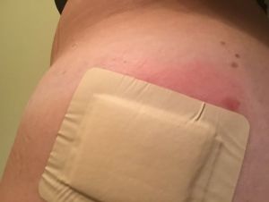 Có phải tôi đã bị nhiễm trùng sau hút mỡ không?