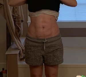 Tôi đã làm hút mỡ bụng được 7 tuần mà vẫn bị sưng – xin hãy xem ảnh và cho tôi biết liệu tình trạng này có thể cải thiện hay không?