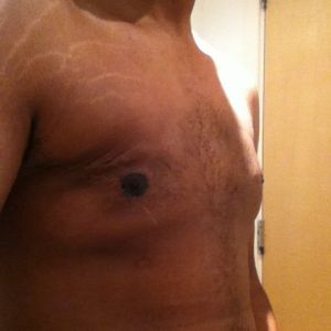 Hút mỡ từ 1 tháng trước, loại bỏ mô ở cả hai bên ngực, sau đó bị tụ dịch – phải chữa như thế nào?