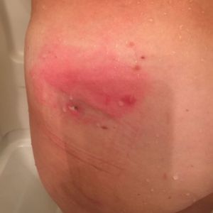 Có phải tôi đã bị nhiễm trùng sau hút mỡ không?