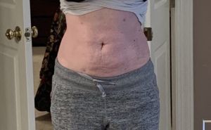 Tôi đã làm hút mỡ bụng được 7 tuần mà vẫn bị sưng – xin hãy xem ảnh và cho tôi biết liệu tình trạng này có thể cải thiện hay không?