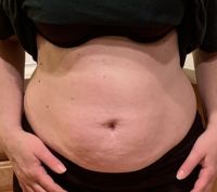 Tôi đã làm hút mỡ bụng được 7 tuần mà vẫn bị sưng – xin hãy xem ảnh và cho tôi biết liệu tình trạng này có thể cải thiện hay không?
