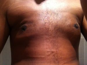 Hút mỡ từ 1 tháng trước, loại bỏ mô ở cả hai bên ngực, sau đó bị tụ dịch – phải chữa như thế nào?