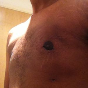 Hút mỡ từ 1 tháng trước, loại bỏ mô ở cả hai bên ngực, sau đó bị tụ dịch – phải chữa như thế nào?