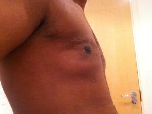 Hút mỡ từ 1 tháng trước, loại bỏ mô ở cả hai bên ngực, sau đó bị tụ dịch – phải chữa như thế nào?