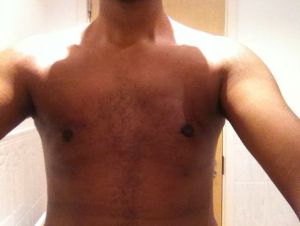 Hút mỡ từ 1 tháng trước, loại bỏ mô ở cả hai bên ngực, sau đó bị tụ dịch – phải chữa như thế nào?