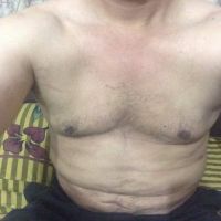Bụng tôi có một nếp gấp sau hút mỡ mặc dù đã mặc đồ nịt liên tục trong 3 tuần dù khó chịu - điều đó có bình thường không?