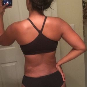 Có cơn đau mới, cảm giác bỏng và căng ở ụ hông 4 tháng sau hút mỡ - một tháng trước tôi không hề gặp tình trạng này