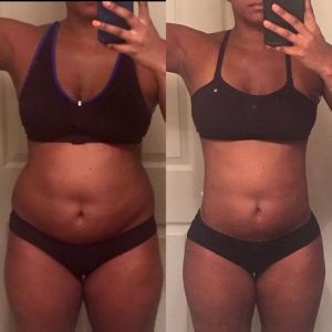 Có cơn đau mới, cảm giác bỏng và căng ở ụ hông 4 tháng sau hút mỡ - một tháng trước tôi không hề gặp tình trạng này