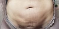 Ổ tụ dịch cứng đầu mãi không khỏi – có thể mặc kệ ổ tụ dịch trong bao lâu trước khi nó gây vấn đề? Ổ tụ dịch cứng đầu mãi không khỏi – có thể mặc kệ ổ tụ dịch trong bao lâu trước khi nó gây vấn đề?
