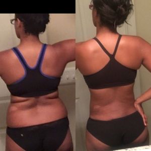 Có cơn đau mới, cảm giác bỏng và căng ở ụ hông 4 tháng sau hút mỡ - một tháng trước tôi không hề gặp tình trạng này