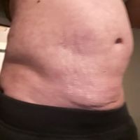 Có rất nhiều mô sẹo gây đau ở bụng trên sau hút mỡ Có rất nhiều mô sẹo gây đau ở bụng trên sau hút mỡ