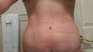 5 tháng sau hút mỡ mà vẫn còn hai “cục u” lồi ra ở bụng dưới – là sưng nề hay tụ dịch?