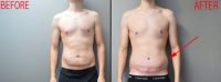 Tôi đã làm hút mỡ và tạo hình thành bụng được 5 tuần nhưng vẫn bị sưng nề to – điều này có bình thường không? Tôi đã làm hút mỡ và tạo hình thành bụng được 5 tuần nhưng vẫn bị sưng nề to – điều này có bình thường không?