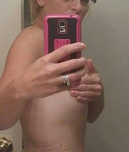 5 tháng sau hút mỡ mà vẫn còn hai “cục u” lồi ra ở bụng dưới – là sưng nề hay tụ dịch?