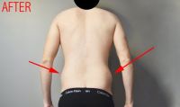 Tôi đã làm hút mỡ và tạo hình thành bụng được 5 tuần nhưng vẫn bị sưng nề to – điều này có bình thường không? Tôi đã làm hút mỡ và tạo hình thành bụng được 5 tuần nhưng vẫn bị sưng nề to – điều này có bình thường không?