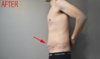 Tôi đã làm hút mỡ và tạo hình thành bụng được 5 tuần nhưng vẫn bị sưng nề to – điều này có bình thường không? Tôi đã làm hút mỡ và tạo hình thành bụng được 5 tuần nhưng vẫn bị sưng nề to – điều này có bình thường không?
