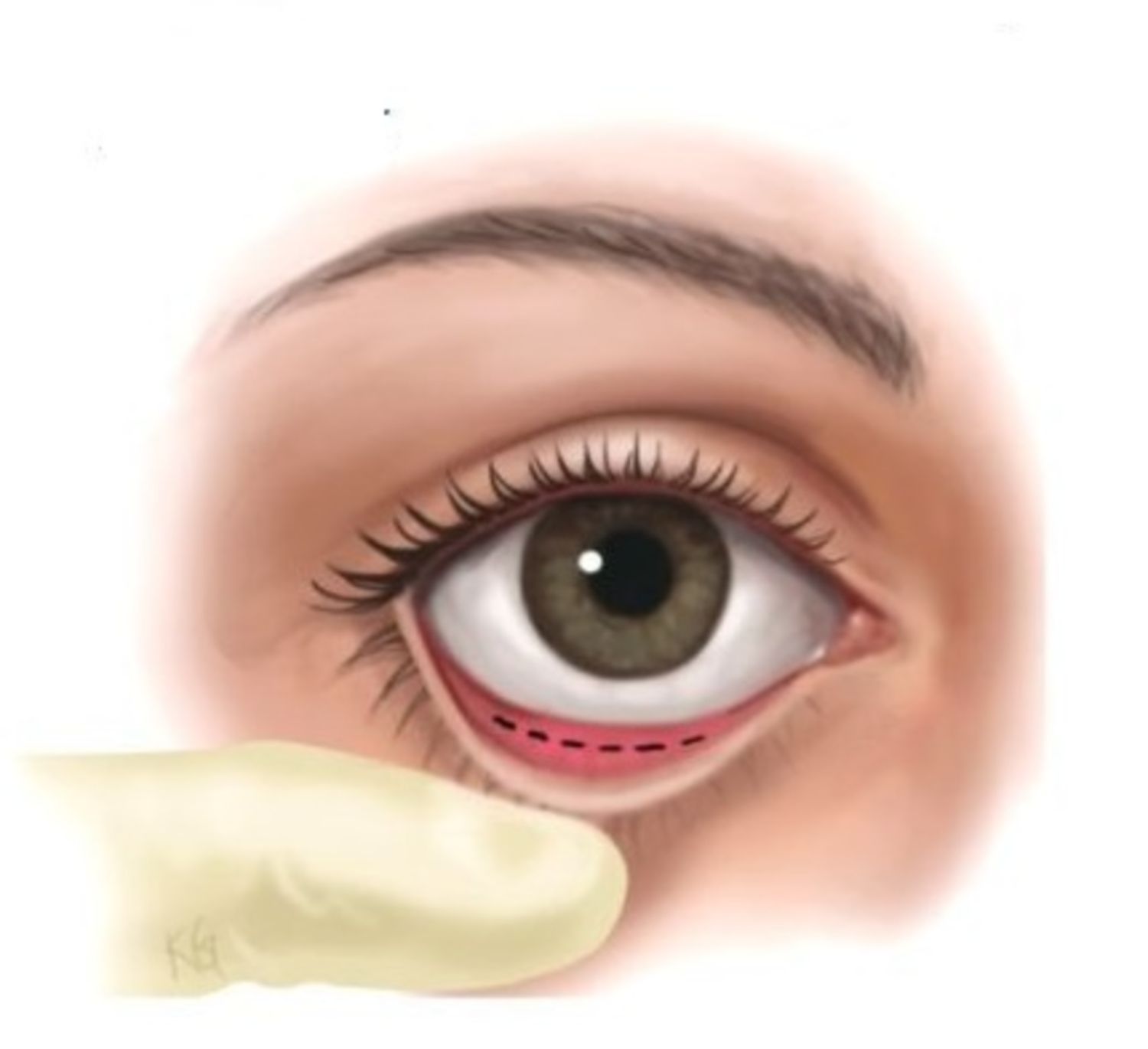 đường rạch qua kết mạc