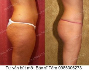 Hút mỡ đùi, nữ 32 tuổi - ca 31