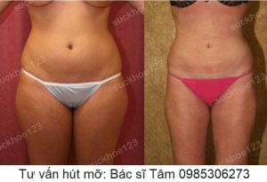 Hút mỡ đùi, nữ 32 tuổi - ca 31