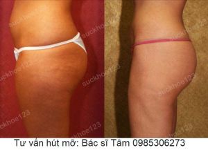 Hút mỡ đùi, nữ 32 tuổi - ca 31