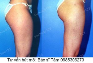 Hút mỡ đùi - ca 32