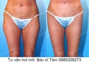 Hút mỡ đùi - ca 32