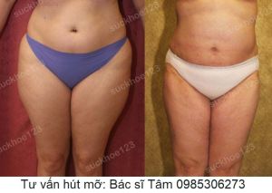 Hút mỡ đùi, nữ 37 tuổi - ca 33