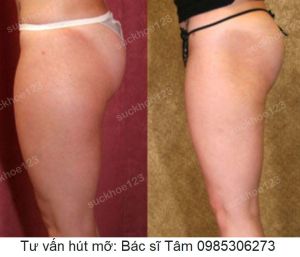 Hút mỡ đùi - ca 34