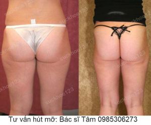 Hút mỡ đùi - ca 34