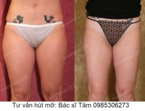 Hút mỡ đùi - ca 34