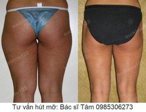 Hút mỡ đùi - ca 35