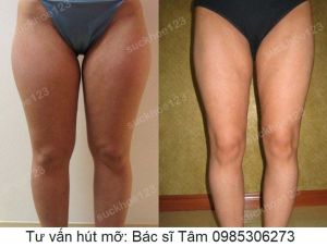 Hút mỡ đùi - ca 35