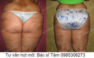 Hút mỡ đùi - ca 36
