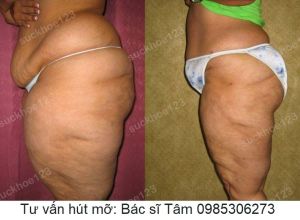 Hút mỡ đùi - ca 36