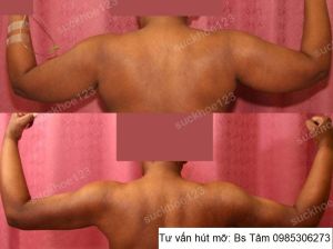 Hút mỡ cánh tay, nữ 45 tuổi - ca 37