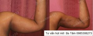 Hút mỡ cánh tay, nữ 45 tuổi - ca 37