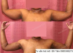 Hút mỡ cánh tay, nữ 45 tuổi - ca 37