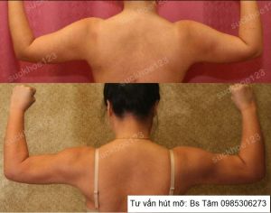 Hút mỡ cánh tay, nữ 30 tuổi - ca 38