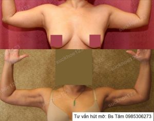 Hút mỡ cánh tay, nữ 30 tuổi - ca 38