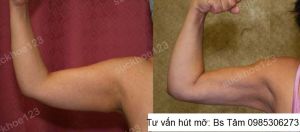 Hút mỡ cánh tay, nữ 45 tuổi - ca 39