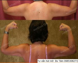 Hút mỡ cánh tay, nữ 45 tuổi - ca 39