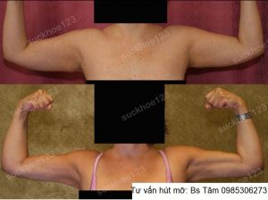Hút mỡ cánh tay, nữ 45 tuổi - ca 39