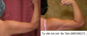 Hút mỡ cánh tay, nữ 45 tuổi - ca 39